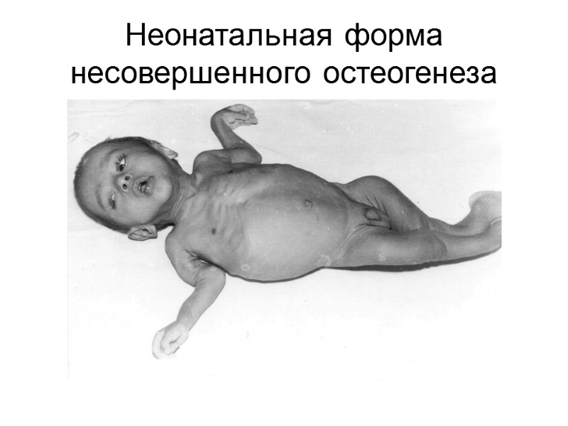 Неонатальная форма несовершенного остеогенеза